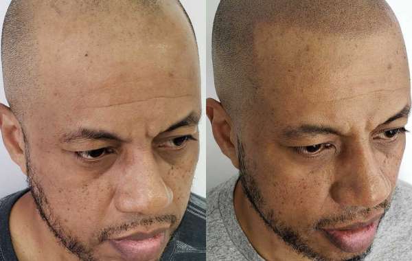 scalp micropigmentation los angeles