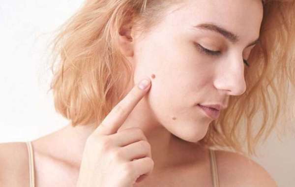 Flawless Perfect Skin Tag Remover (Scam Or Trusted) Beware Before Buying